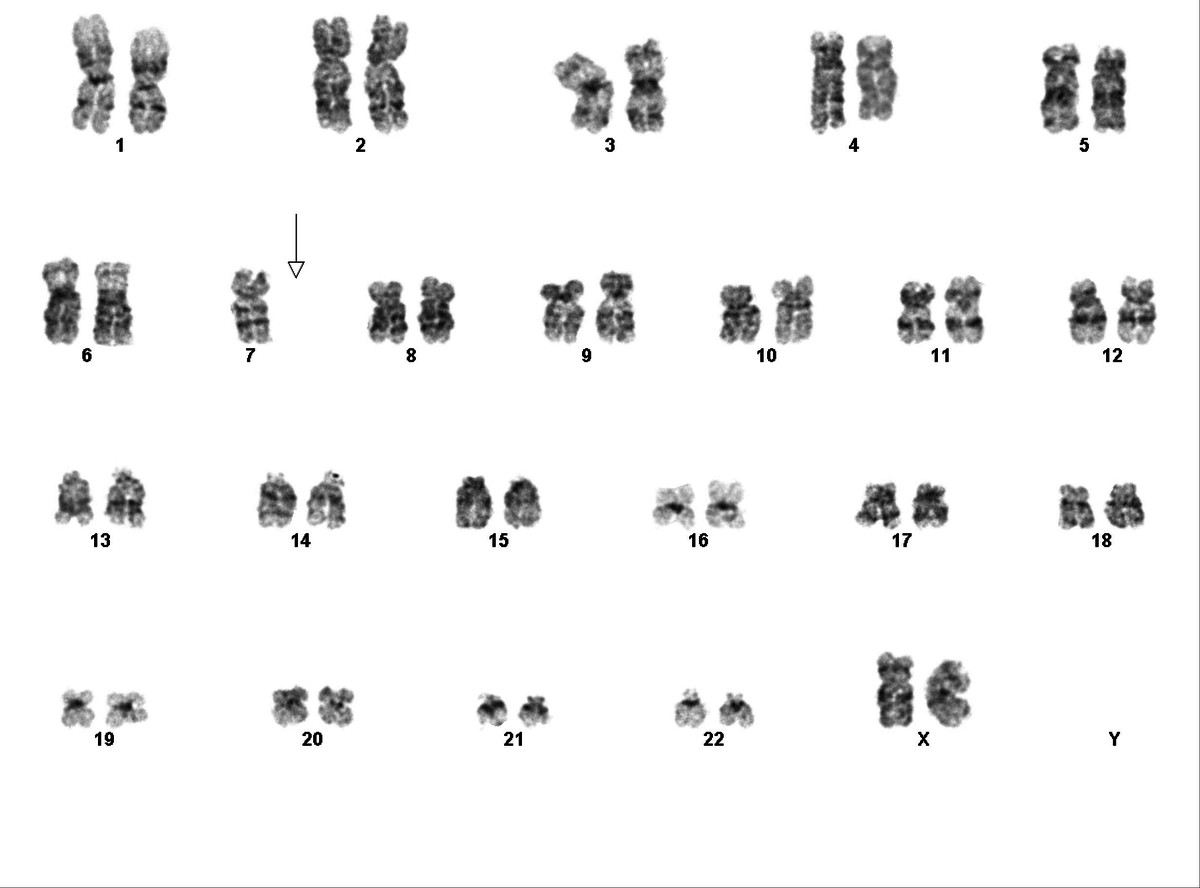 Karyotype showing deletion of chromosome 7.